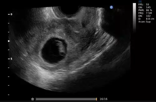 Ultrassom E5