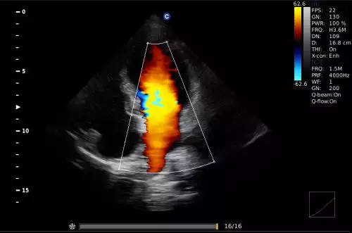 Ultrassom E5