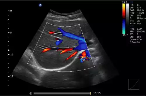 Ultrassom E5