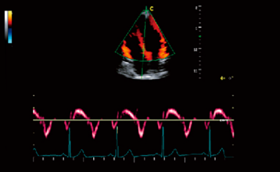Imagem Doppler Tecidual (TDI)