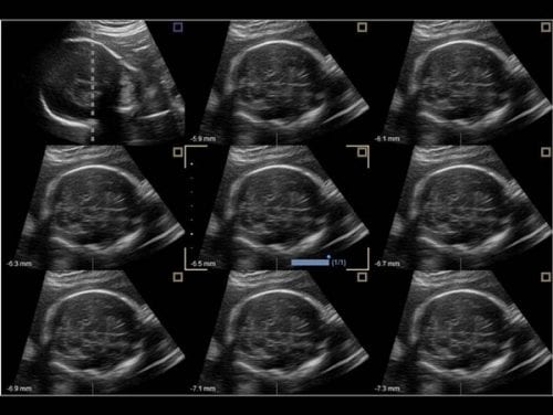 Cérebro fetal em MSV (exibição de várias fatias)