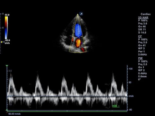 Fluxo da válvula mitral em PW