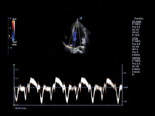 Septo interventricular em imagens de Doppler tecidual