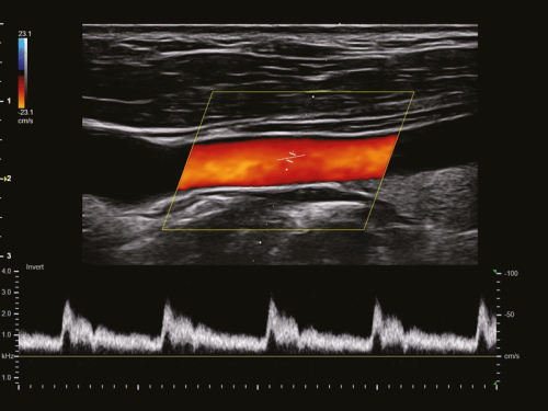Artéria carótida em modo PW