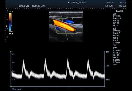 1-2 Carotid in PW Mode