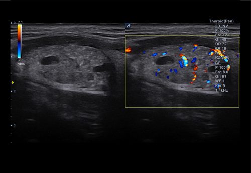 3-1 Thyroid in Dual mode