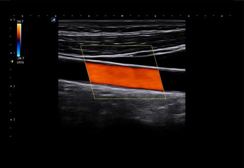 3-3 Carotid in Color mode