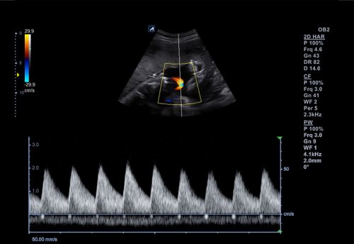 3-5 Umbilical Cord in PW (Xpeed_after)