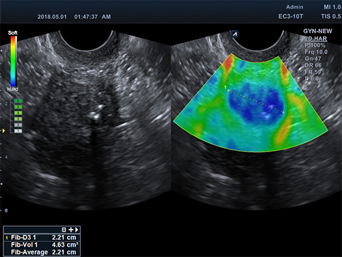 Elastography