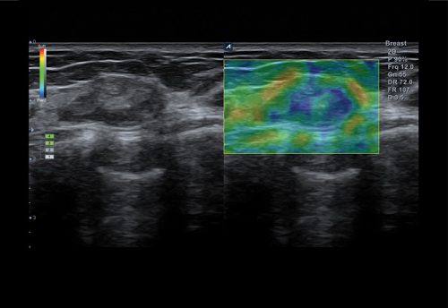 Elastography