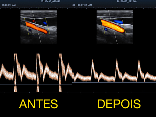 Xpeed™_before-after