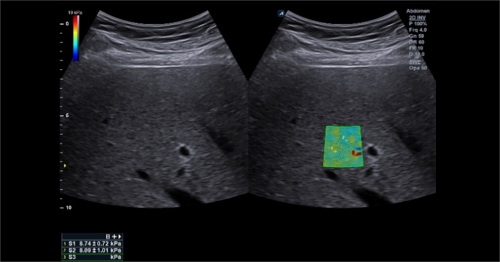 Elastografia Shear Wave 2D