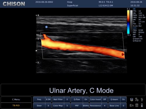 25(Ulnar,C)