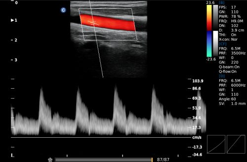 carotidú