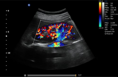 kidney, c mode