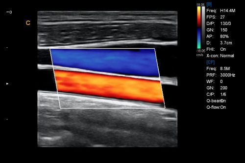 linear carotid1D12 C