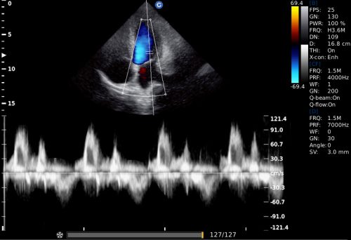 mitral valve ,D